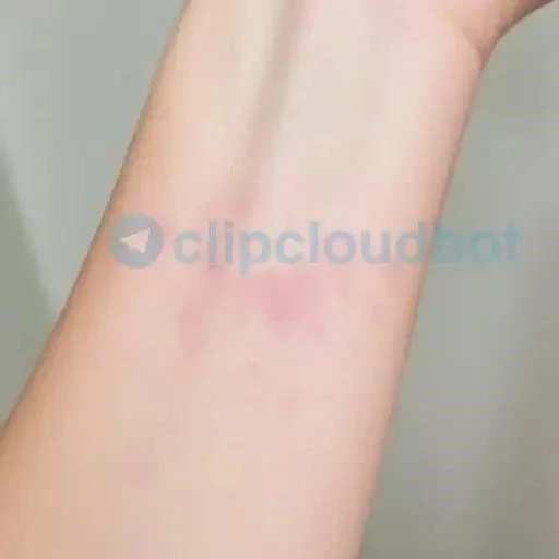 Сыпь, ассоциированная со стрессом